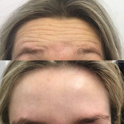 BOTOX/Dysport Before & After Gallery - Patient 104345 - Image 1