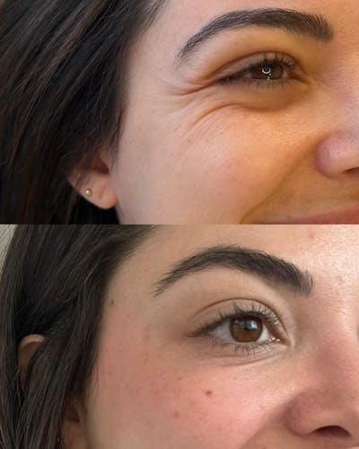 BOTOX/Dysport Before & After Gallery - Patient 385384 - Image 1