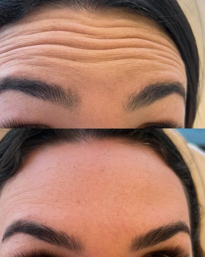 BOTOX/Dysport Before & After Gallery - Patient 295013 - Image 1