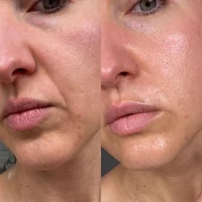 Chemical Peels Before & After Gallery - Patient 158026 - Image 1