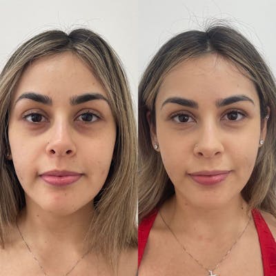 PRP Eye Rejuvenation Before & After Gallery - Patient 427520 - Image 1