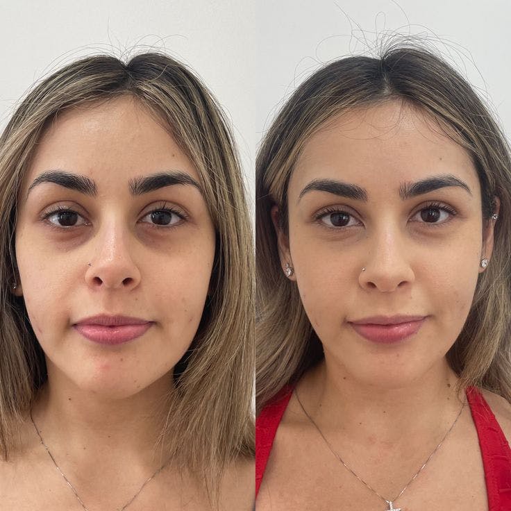 PRP Eye Rejuvenation Before & After Gallery - Patient 427520 - Image 1