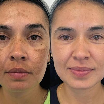Chemical Peels Before & After Gallery - Patient 139255 - Image 1