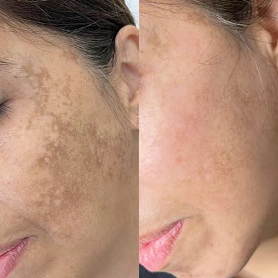 Chemical Peels Before & After Gallery - Patient 258642 - Image 1