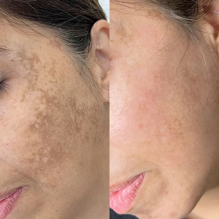 Chemical Peels Before & After Gallery - Patient 258642 - Image 1