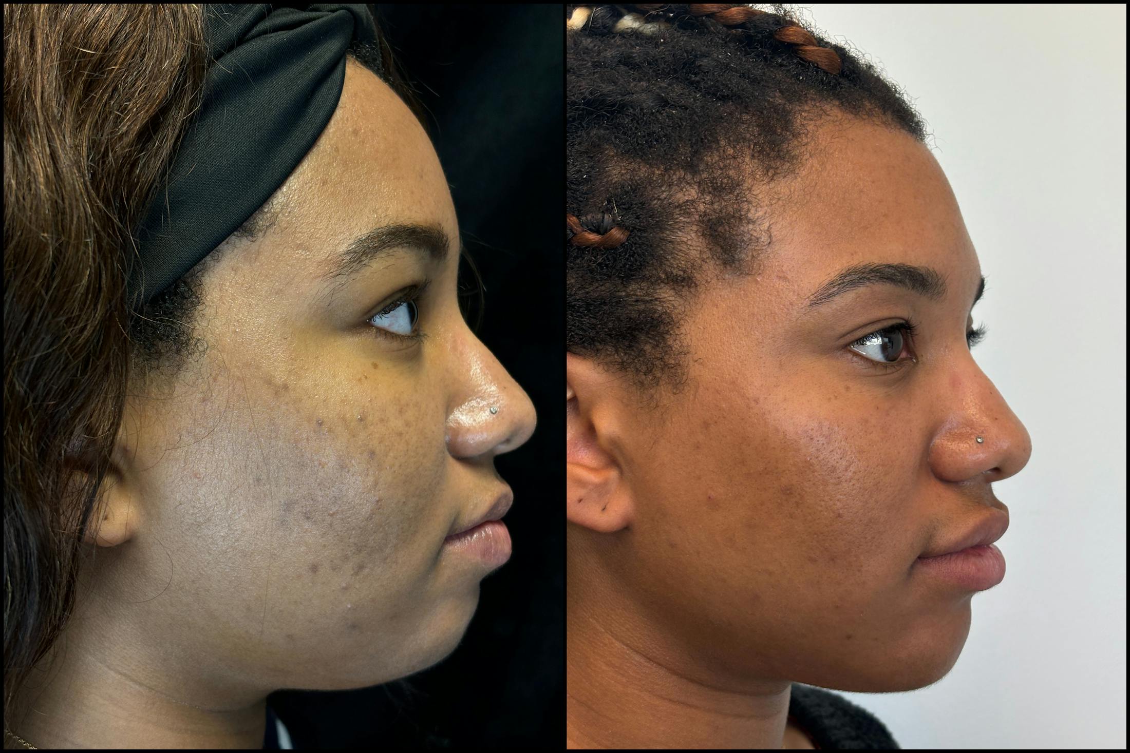 Evoke Before & After Gallery - Patient 357101 - Image 1