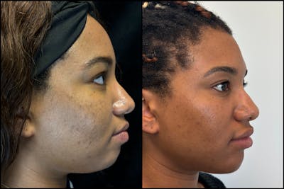 Evoke Before & After Gallery - Patient 357101 - Image 1