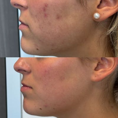 Medical Grade Facial  Before & After Gallery - Patient 577084 - Image 1