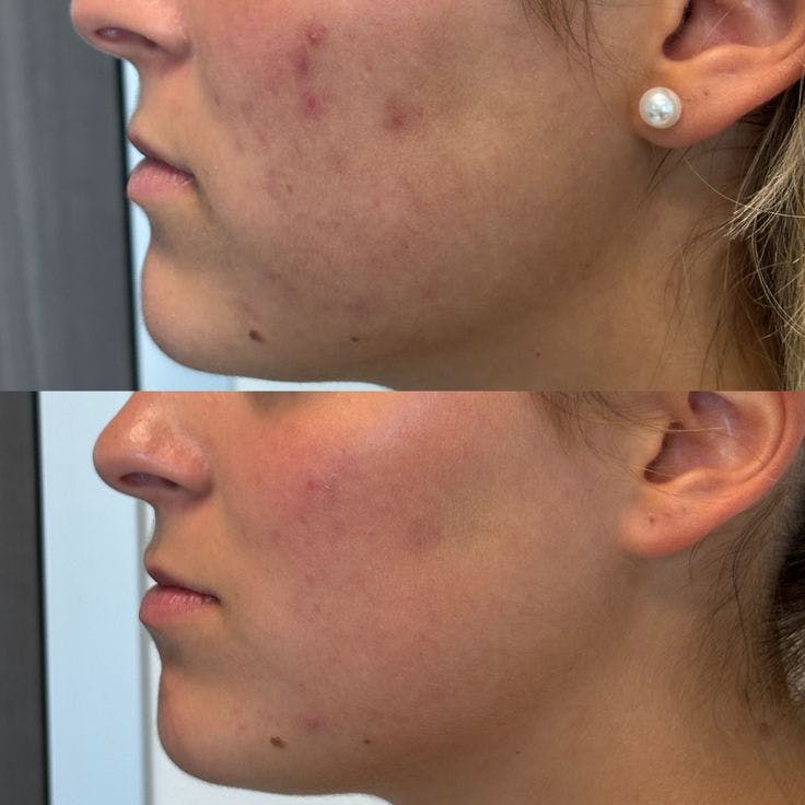 Medical Grade Facial  Before & After Gallery - Patient 577084 - Image 1
