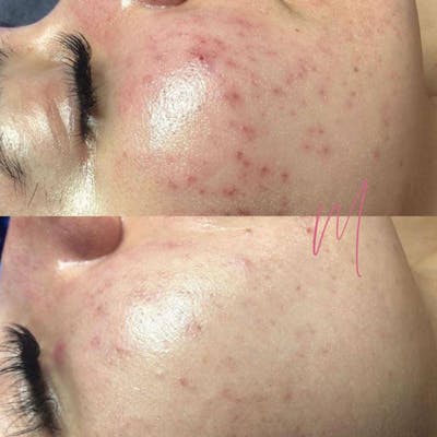 Medical Grade Facial  Before & After Gallery - Patient 123185 - Image 1
