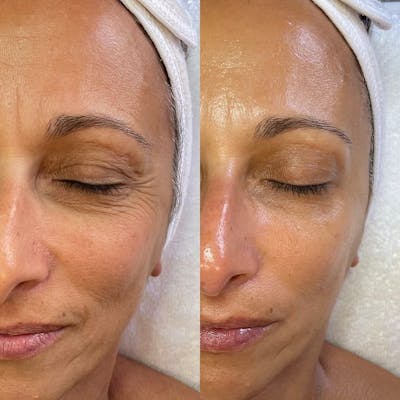 Medical Grade Facial  Before & After Gallery - Patient 153018 - Image 1