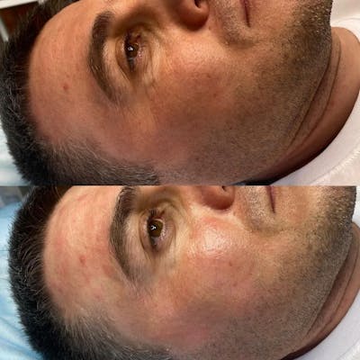 Medical Grade Facial  Before & After Gallery - Patient 412892 - Image 1