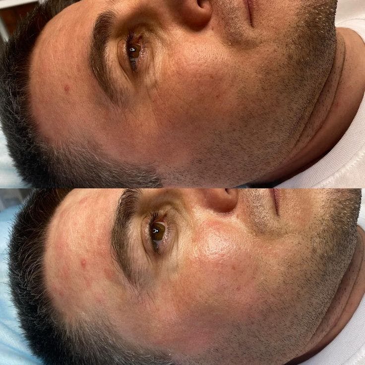 Medical Grade Facial  Before & After Gallery - Patient 412892 - Image 1