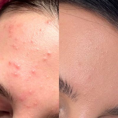 Medical Grade Facial  Before & After Gallery - Patient 218831 - Image 1