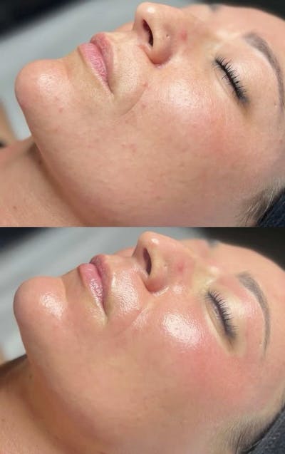 Medical Grade Facial  Before & After Gallery - Patient 348594 - Image 1