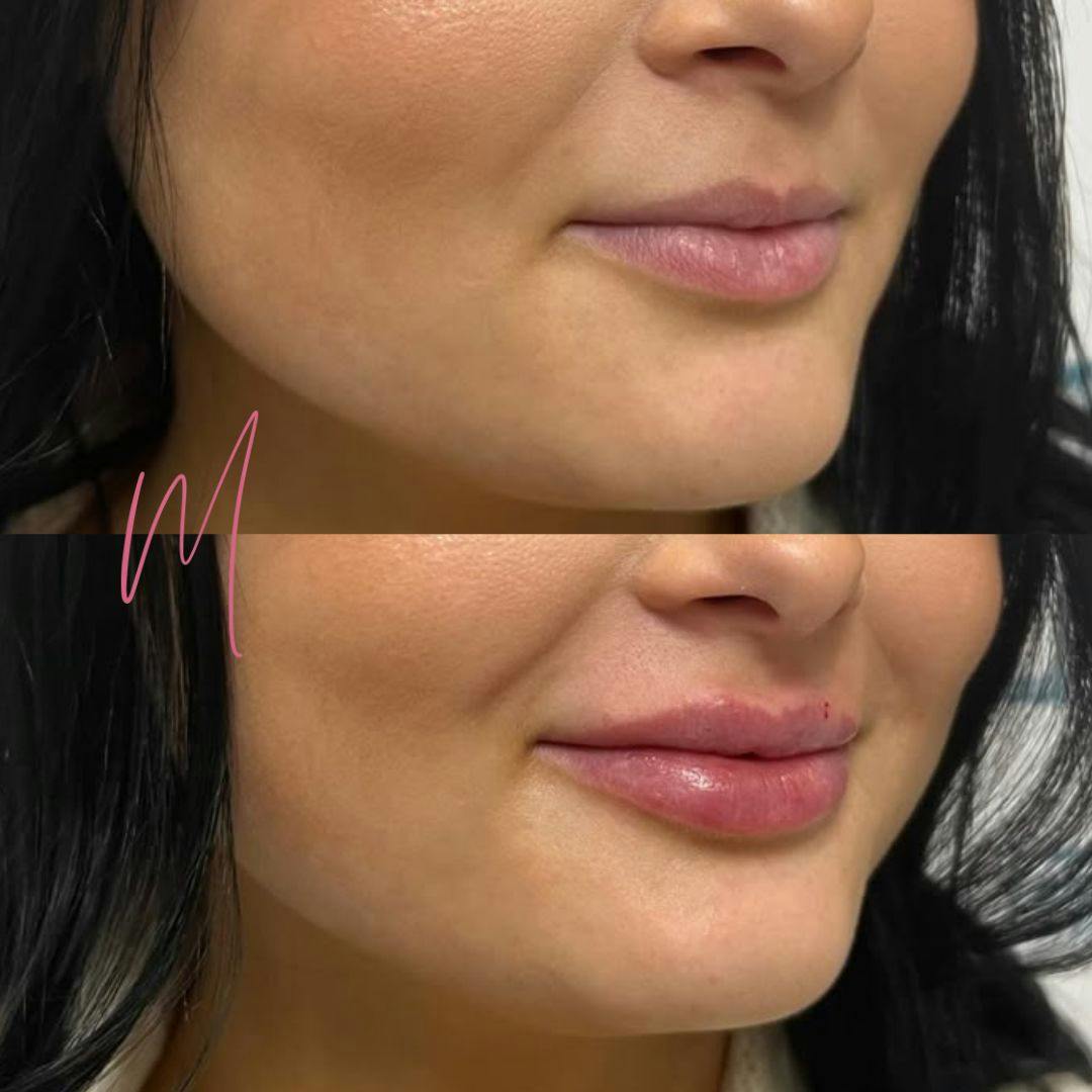 Dermal Fillers Before & After Gallery - Patient 428432 - Image 1