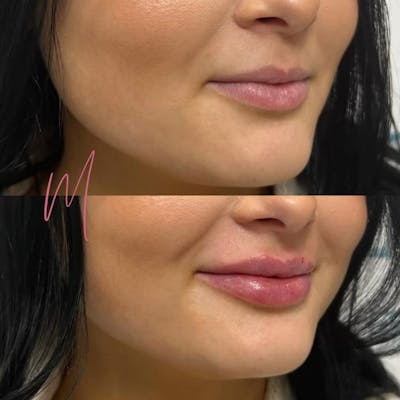 Dermal Fillers Before & After Gallery - Patient 428432 - Image 1