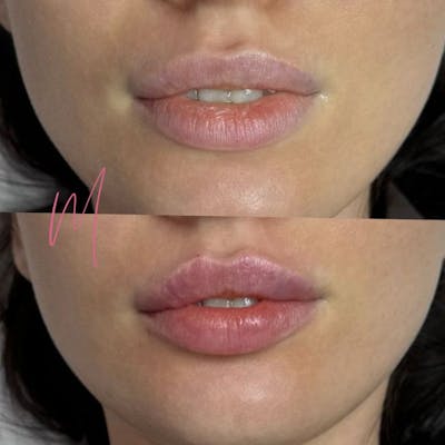 Dermal Fillers Before & After Gallery - Patient 404942 - Image 1