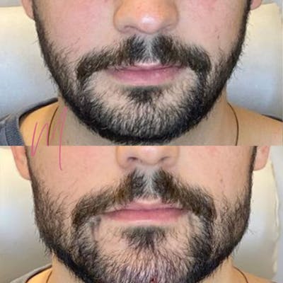 Dermal Fillers Before & After Gallery - Patient 419795 - Image 1