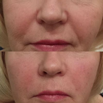 Dermal Fillers Before & After Gallery - Patient 377185 - Image 1