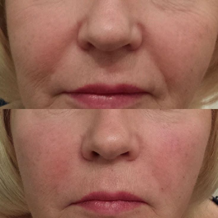 Dermal Fillers Before & After Gallery - Patient 377185 - Image 1