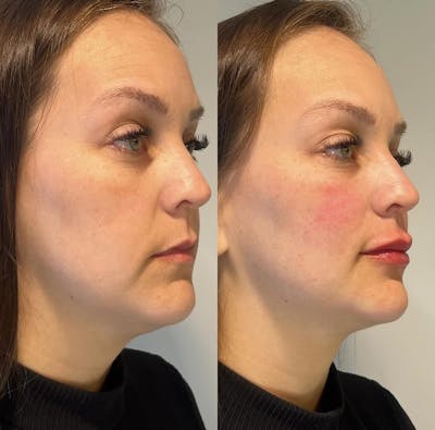 Dermal Fillers Before & After Gallery - Patient 124250 - Image 1