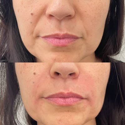 Dermal Fillers Before & After Gallery - Patient 260070 - Image 1