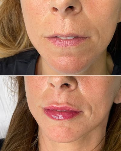 Dermal Fillers Before & After Gallery - Patient 219581 - Image 1
