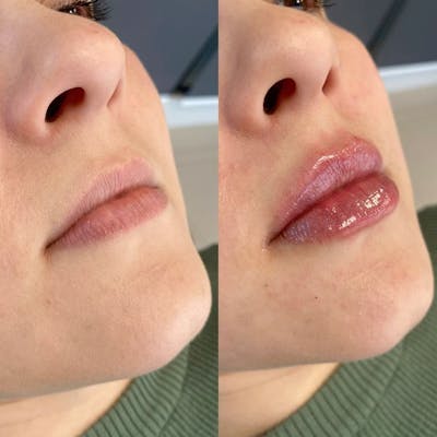 Dermal Fillers Before & After Gallery - Patient 236621 - Image 1