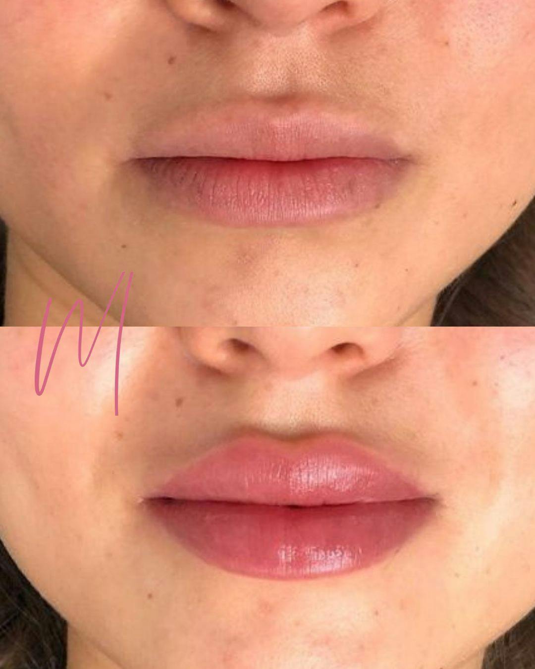 Dermal Fillers Before & After Gallery - Patient 110249 - Image 1