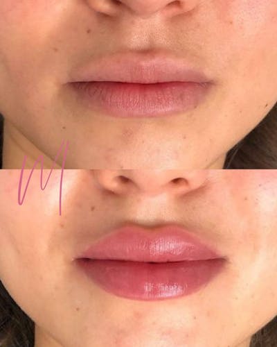 Dermal Fillers Before & After Gallery - Patient 110249 - Image 1