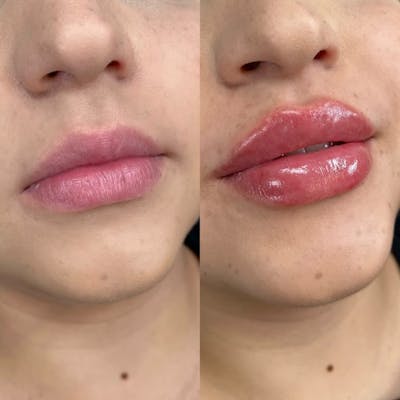 Dermal Fillers Before & After Gallery - Patient 137827 - Image 1