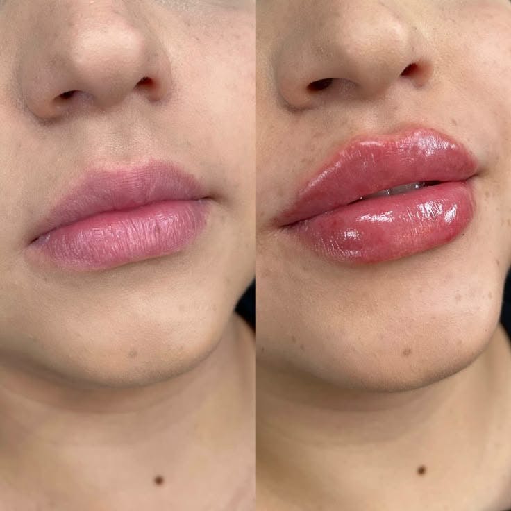 Dermal Fillers Before & After Gallery - Patient 137827 - Image 1