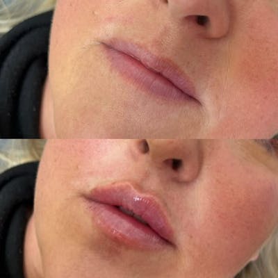Dermal Fillers Before & After Gallery - Patient 122430 - Image 1