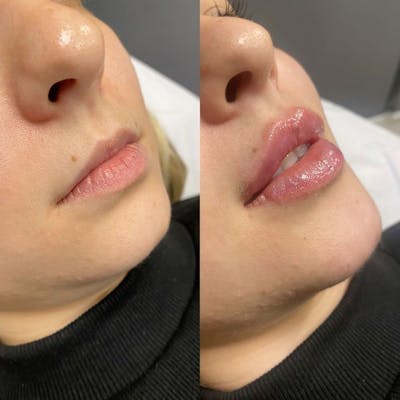 Dermal Fillers Before & After Gallery - Patient 201542 - Image 1