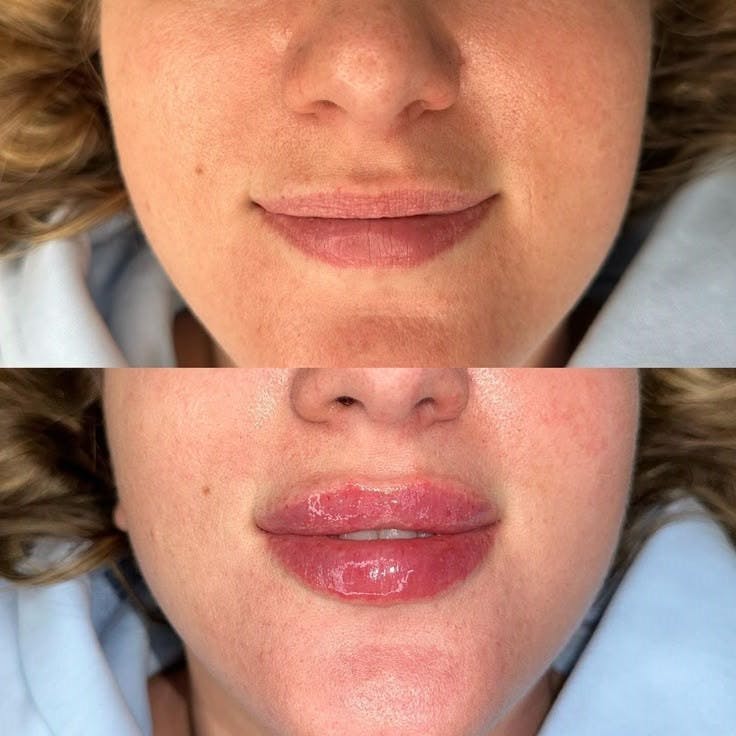 Dermal Fillers Before & After Gallery - Patient 235620 - Image 1