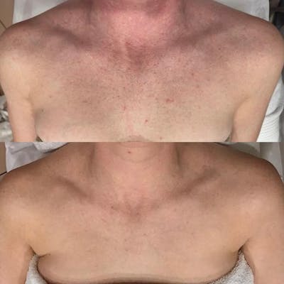IPL for Body Before & After Gallery - Patient 336245 - Image 1