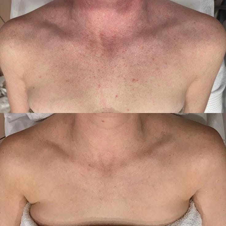 IPL for Body Before & After Gallery - Patient 336245 - Image 1