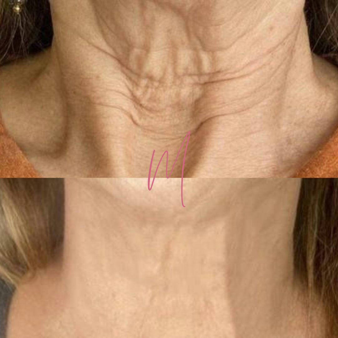 Microneedling Before & After Gallery - Patient 460151 - Image 1