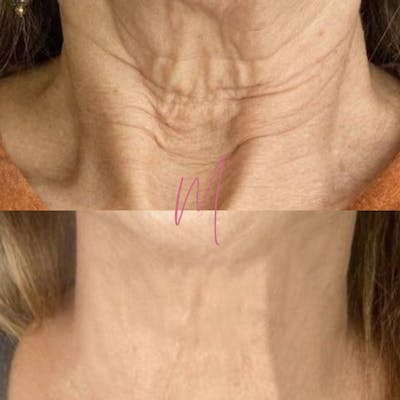 Microneedling Before & After Gallery - Patient 460151 - Image 1