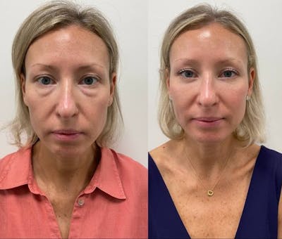 PRP Eye Rejuvenation Before & After Gallery - Patient 137181 - Image 1