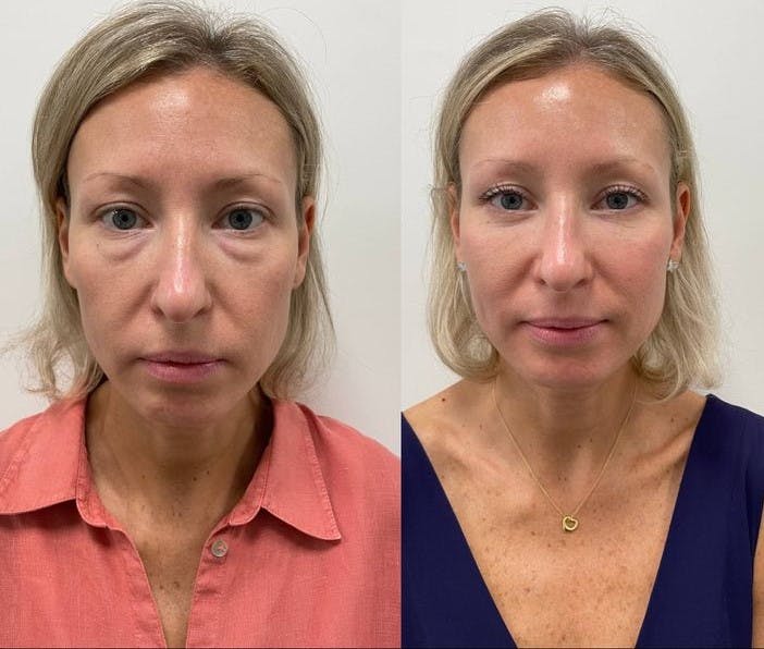 PRP Eye Rejuvenation Before & After Gallery - Patient 137181 - Image 1