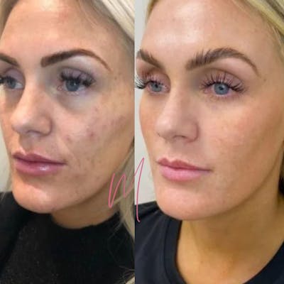 Microneedling Before & After Gallery - Patient 261928 - Image 1