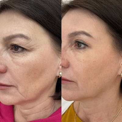 Microneedling Before & After Gallery - Patient 247181 - Image 1
