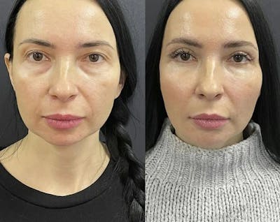 Microneedling Before & After Gallery - Patient 220651 - Image 1