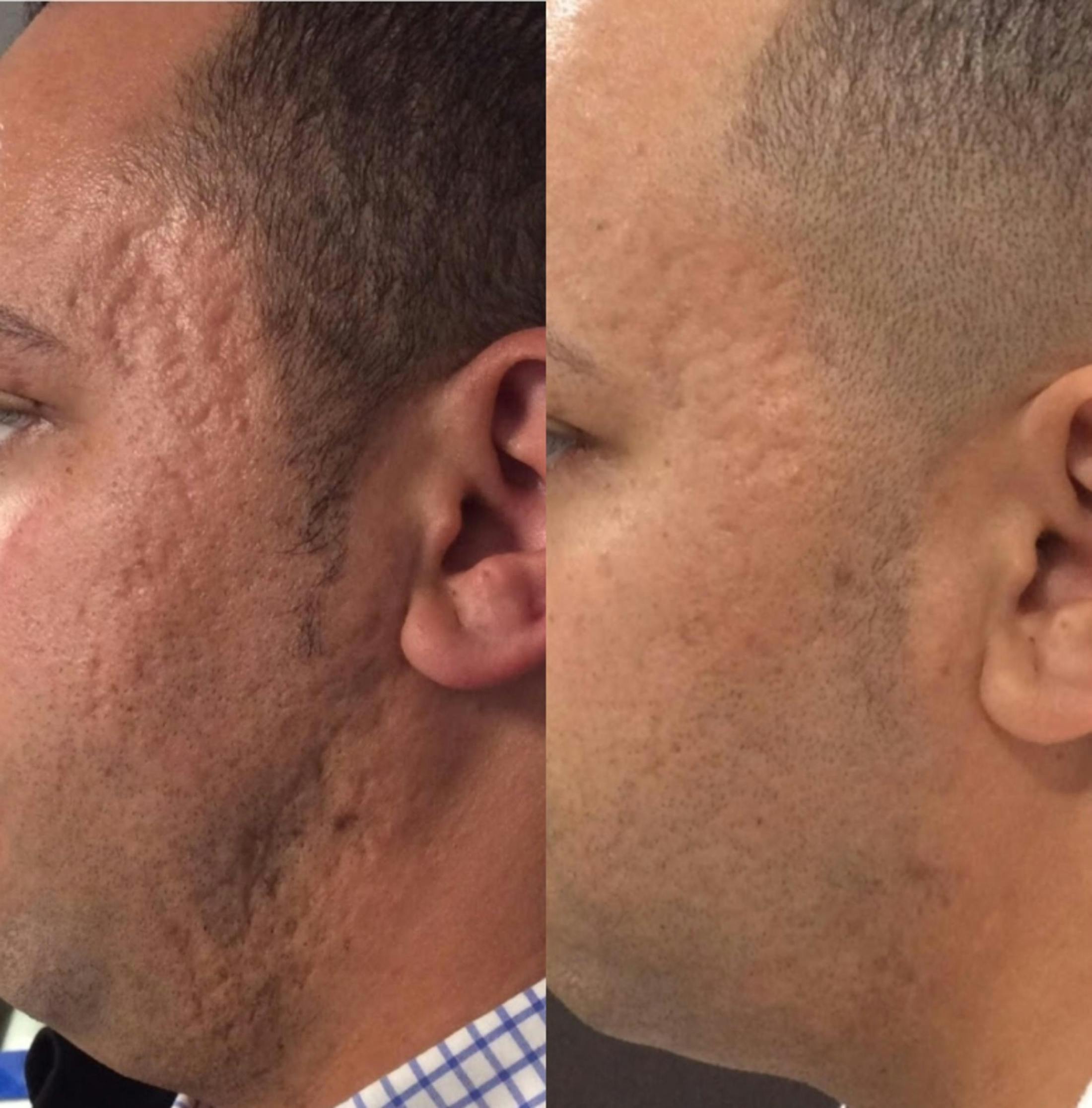 Microneedling Before & After Gallery - Patient 267630 - Image 1