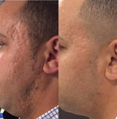 Microneedling Before & After Gallery - Patient 267630 - Image 1