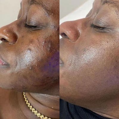 Microneedling Before & After Gallery - Patient 244215 - Image 1