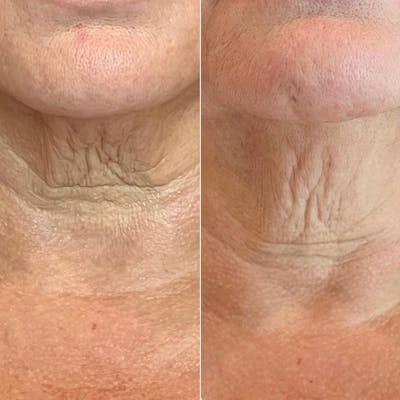 Morpheus8 Before & After Gallery - Patient 377578 - Image 1