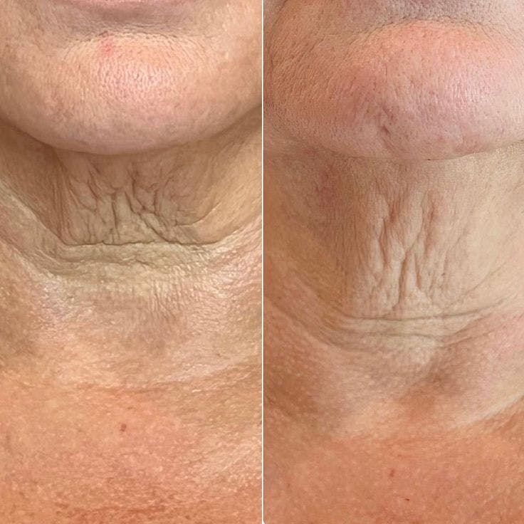 Morpheus8 Before & After Gallery - Patient 377578 - Image 1